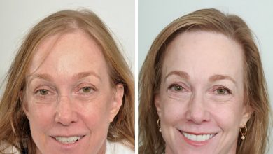 female hair transplant before and after